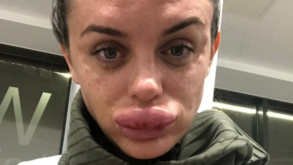 Woman Has An Important Warning For Others After Her Lips Tripled In Size At A 'Botox Party'