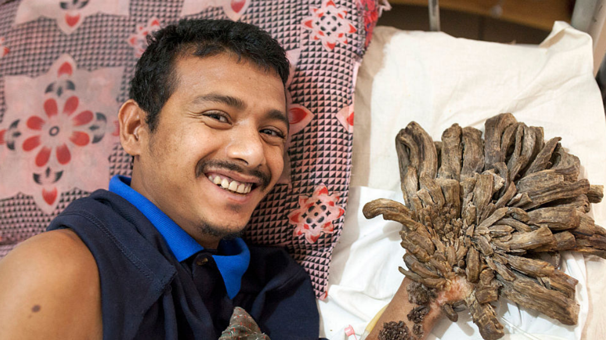 Man Suffering from Rare “Tree Man” Syndrome To Undergo More Surgeries After Growths Return