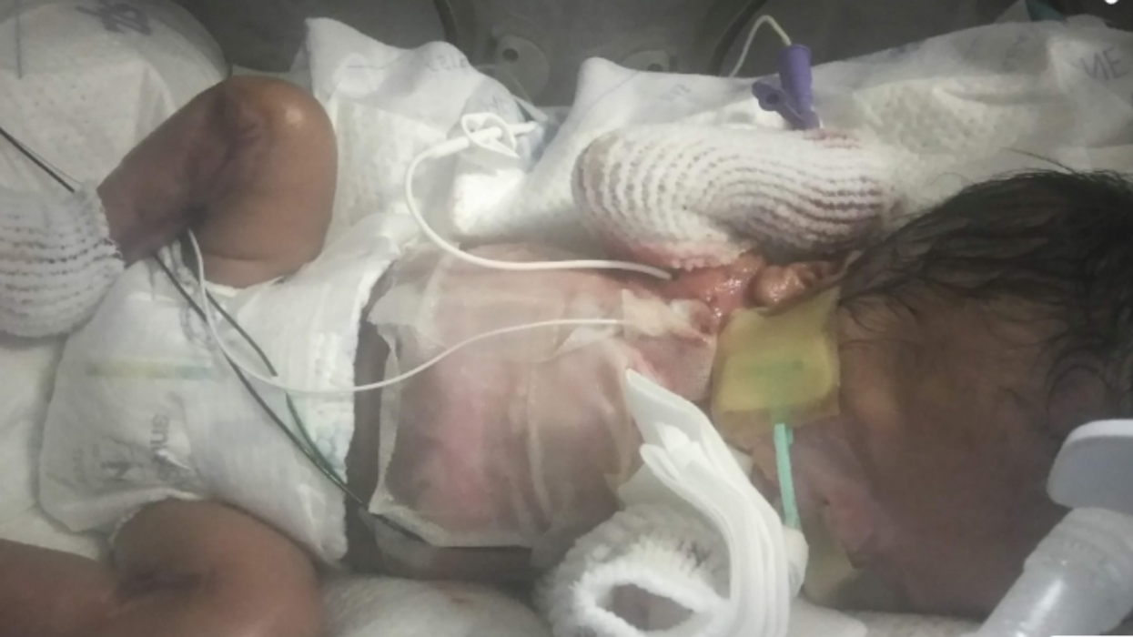 Incredible Miracle: Baby Born Without Skin Thriving in San Antonio