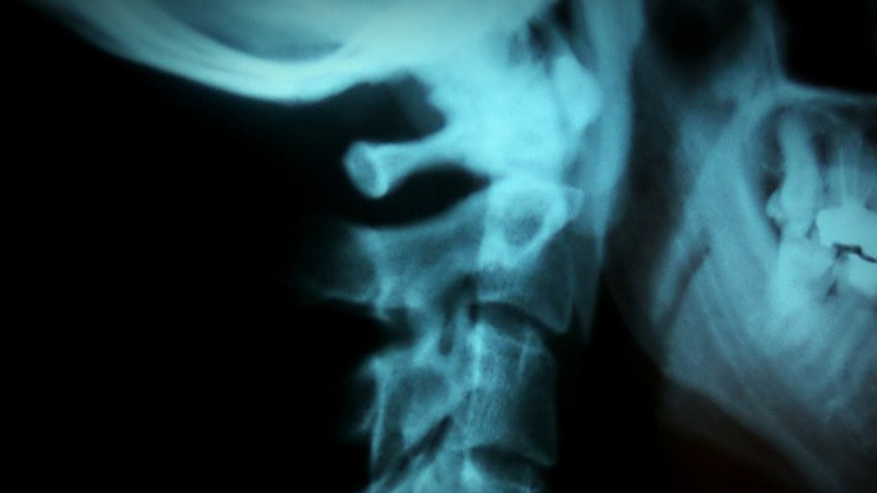 Man Who Was Warned By Wife About 'Cracking' His Neck Regularly Suffers Stroke From The Habit