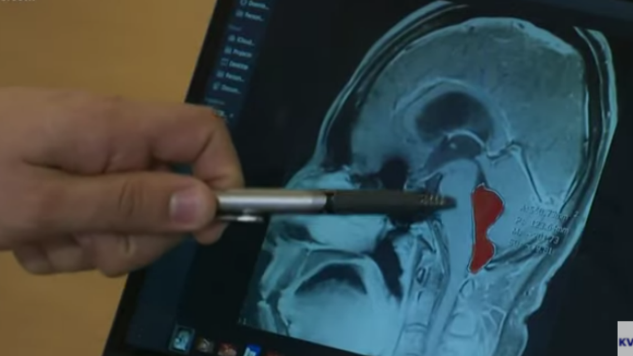 Texas Man's Debilitating Headaches Turned Out To Be Caused By A Tapeworm That Had Been Living In His Brain For Over A Decade