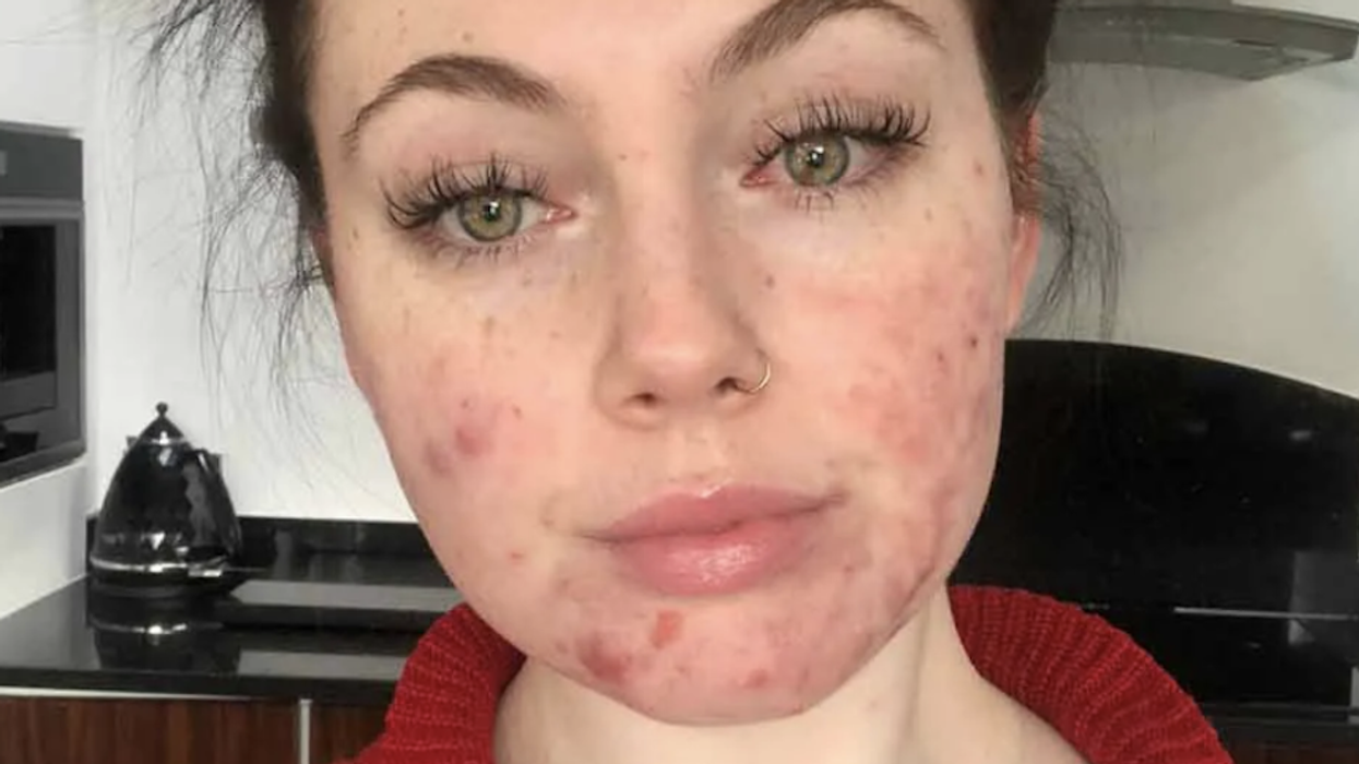 Young Teacher Who Nearly Quit Her Job After Battling Severe Acne Helps Others With The Power Of Social Media