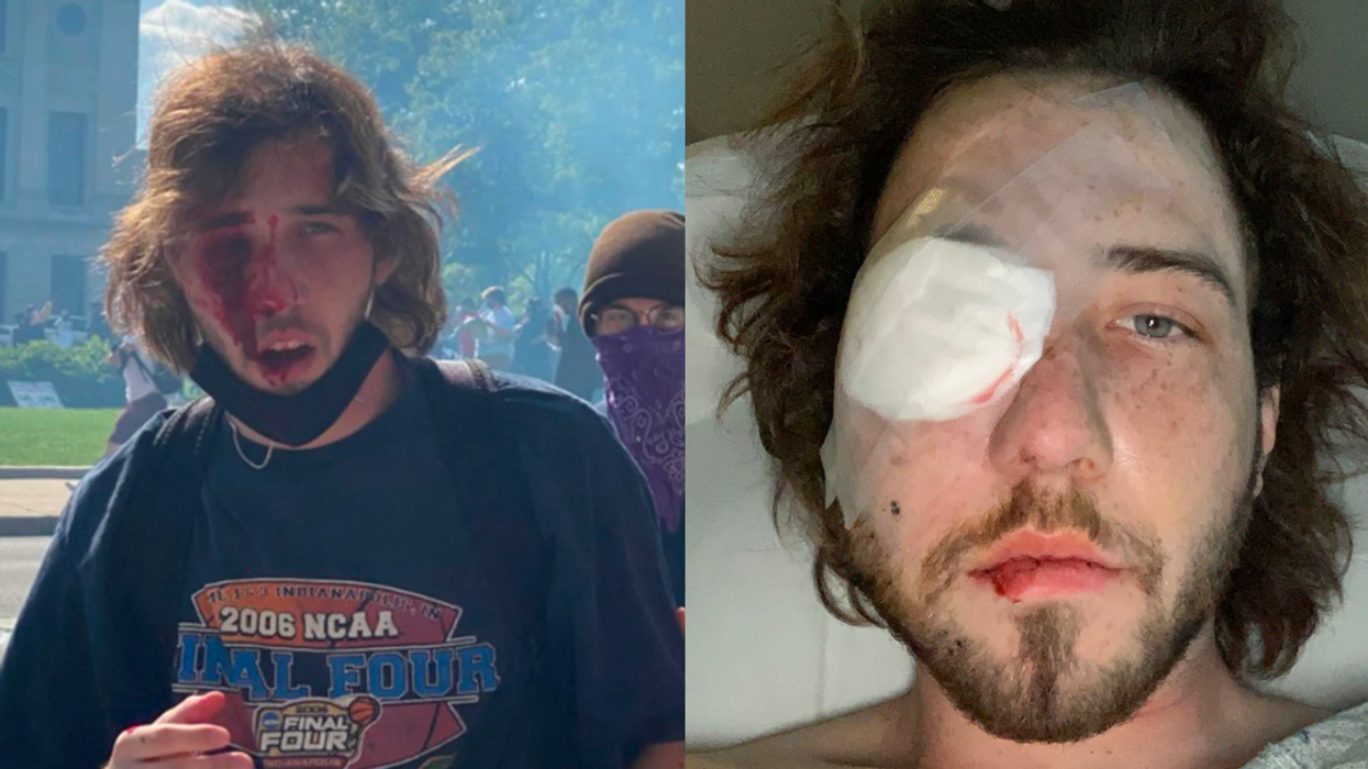 Indiana Protester Loses An Eye After Being Shot In The Face By Police With A Tear Gas Canister
