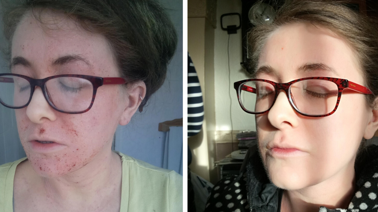 Eczema Sufferer Who Was Called 'Disgusting' By Stranger In Clothing Store Finds Relief With $10 Cream