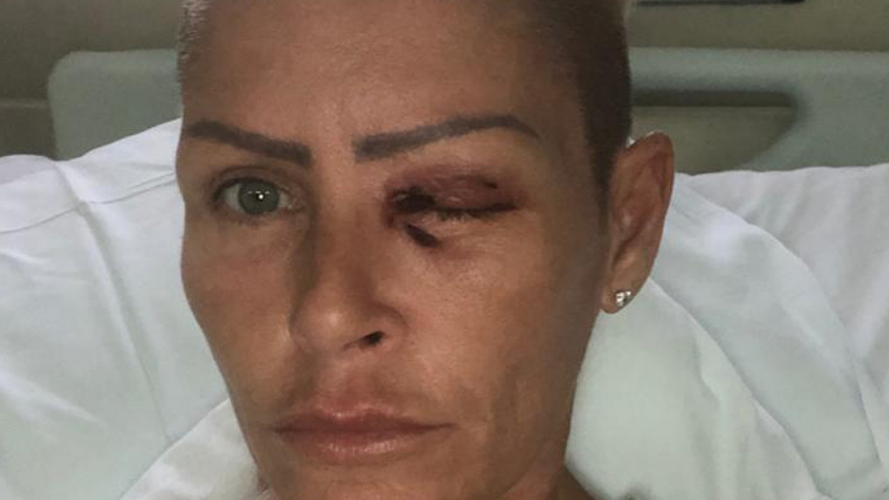 Mom Explains How She Almost Lost An Eye After A Tiny Cut Sparked A Dangerous Eye Infection