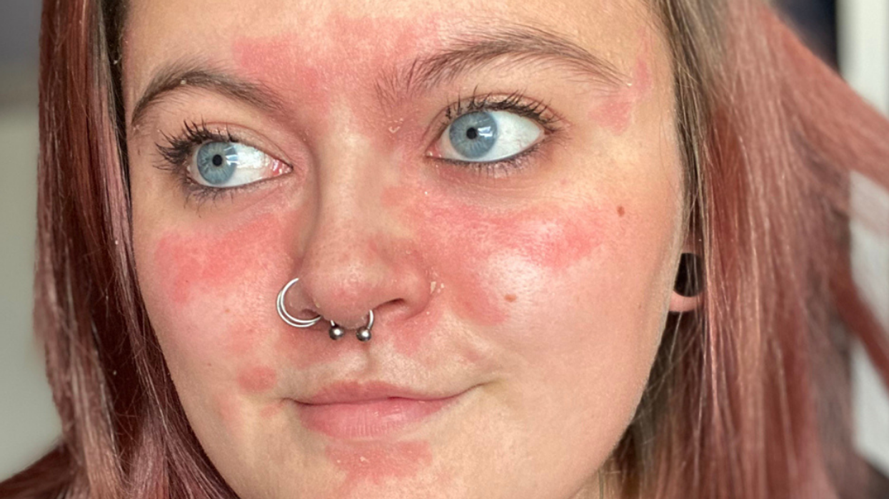 Woman With One Of The 'Worst Cases' Of Psoriasis Her Doctors Had Ever Seen Embraces Condition