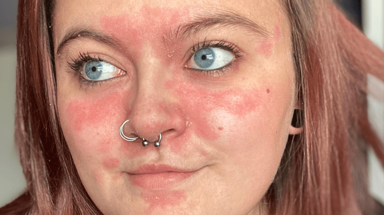 Woman With One Of The 'Worst Cases' Of Psoriasis Her Doctors Had Ever Seen Embraces Condition
