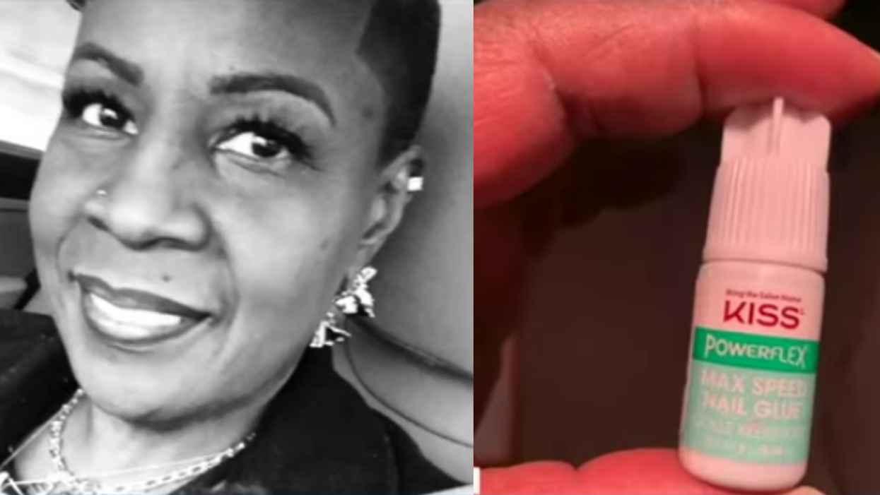 Woman Accidentally Seals Her Eye Shut After Sleepily Mistaking Nail Glue For Eye Drops