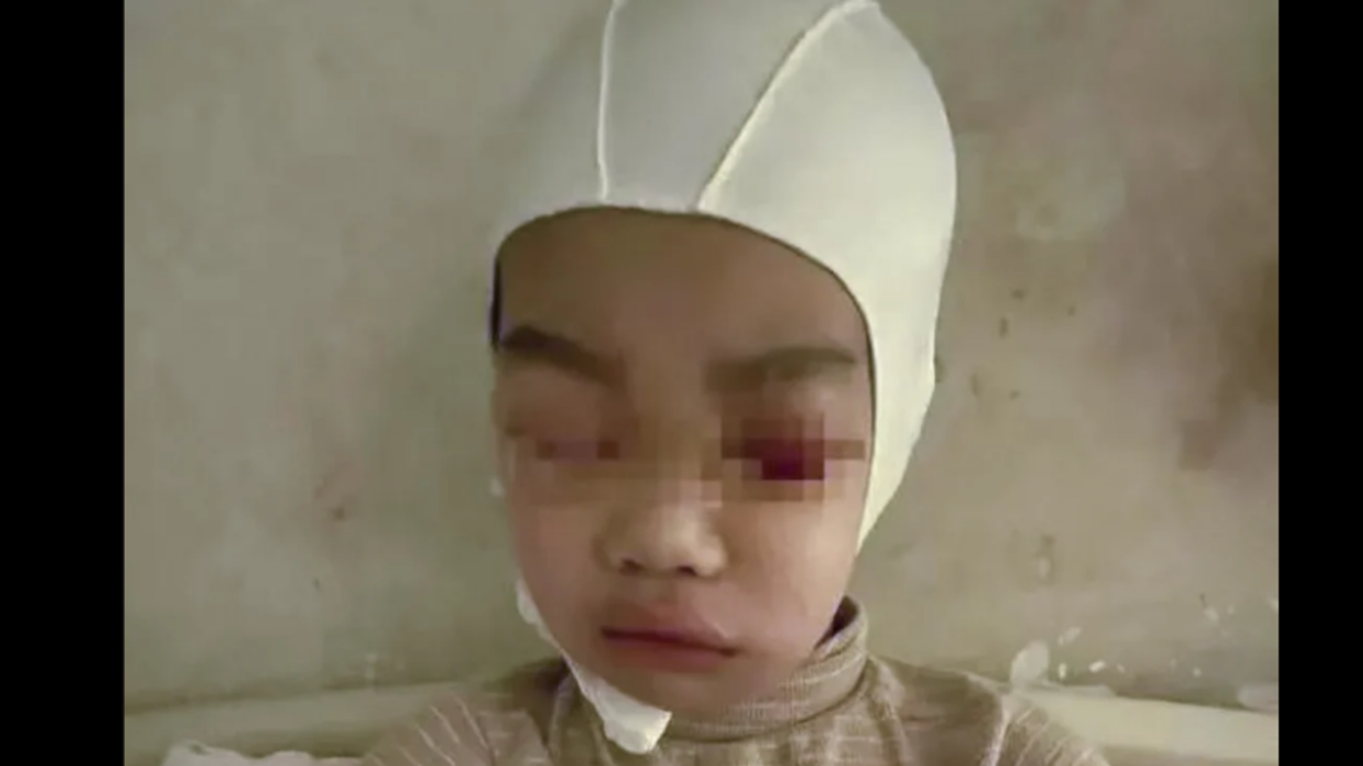 Teacher In China Arrested After Pulling 9-Year-Old Boy's Hair So Hard He Was Left Partially Scalped