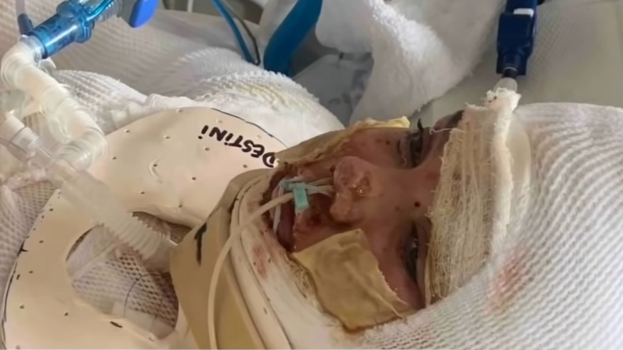 13-Year-Old Girl Permanently Disfigured By 3rd-Degree Burns After Trying To Copy Viral TikTok Trend