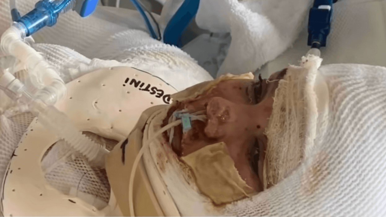 13-Year-Old Girl Permanently Disfigured By 3rd-Degree Burns After Trying To Copy Viral TikTok Trend
