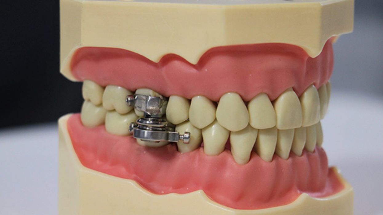 Device That Literally Locks Your Mouth Shut To Keep You From Eating Gets Slammed As 'Torture'