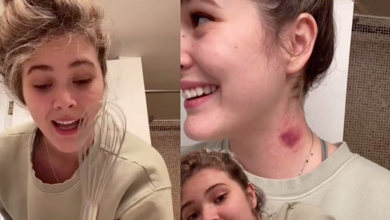 Teen Goes Viral After Discovering Unusual Whisk Hack For Getting Rid Of Hickeys—And It Actually Works