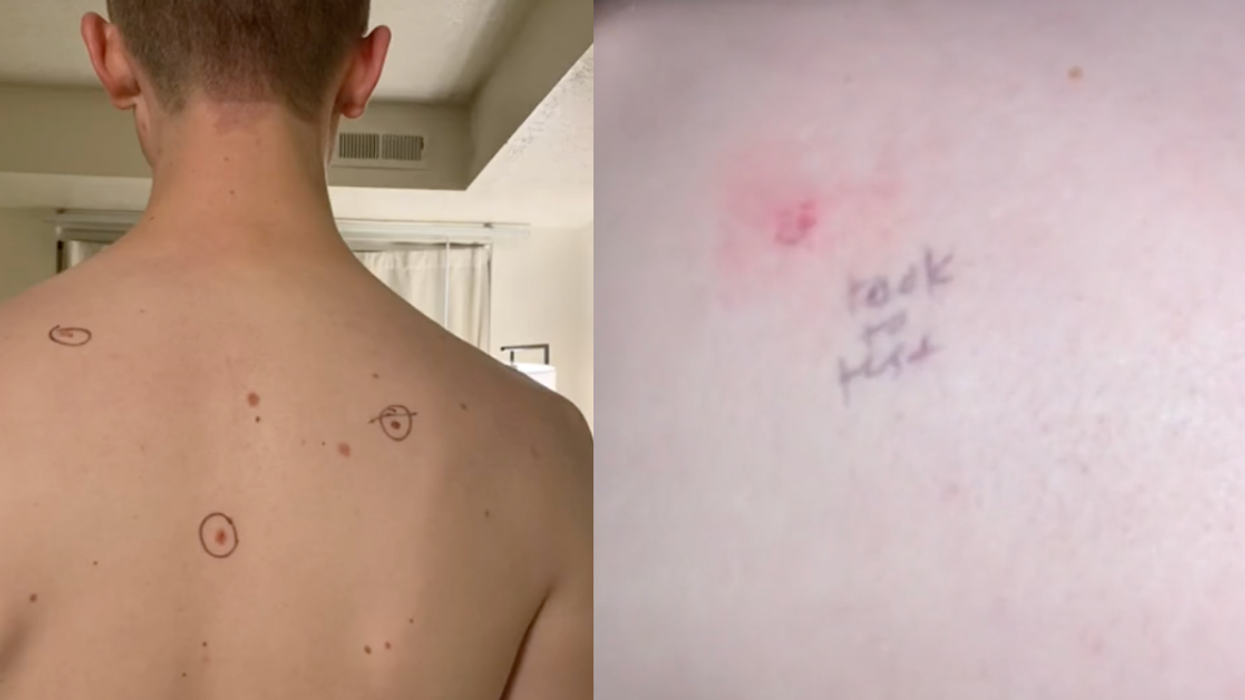Dermatologist Writes Notes Next To Guy's Moles After His Wife Circled Them Out Of Concern