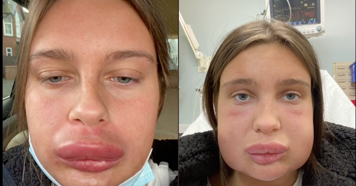 Woman's Face Balloons Up After Treatment To Dissolve Lip Filler Causes Major Allergic Reaction
