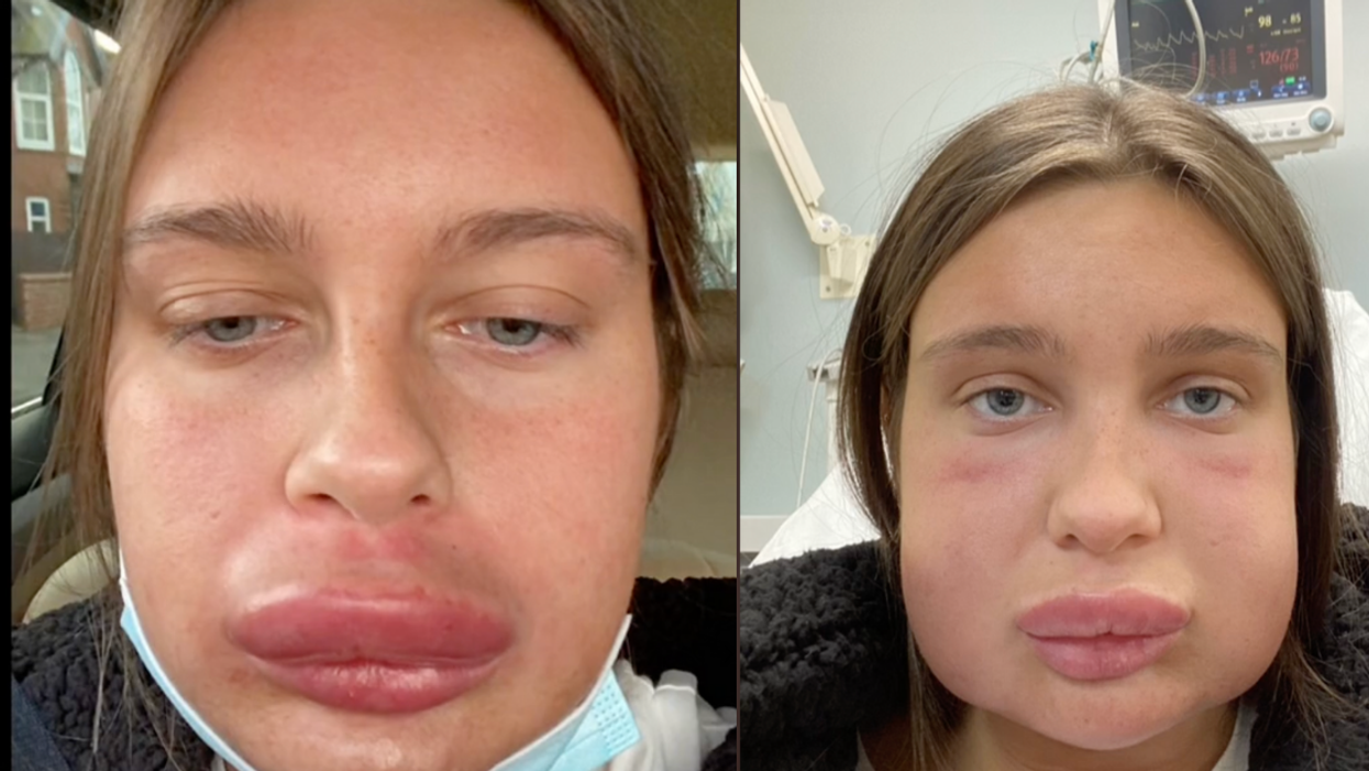 Woman's Face Balloons Up After Treatment To Dissolve Lip Filler Causes Major Allergic Reaction
