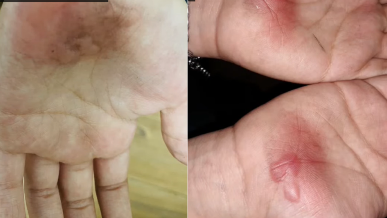 Texas Middle Schoolers Suffer Severe Burns On Their Hands Due To Gym Teacher's Punishment