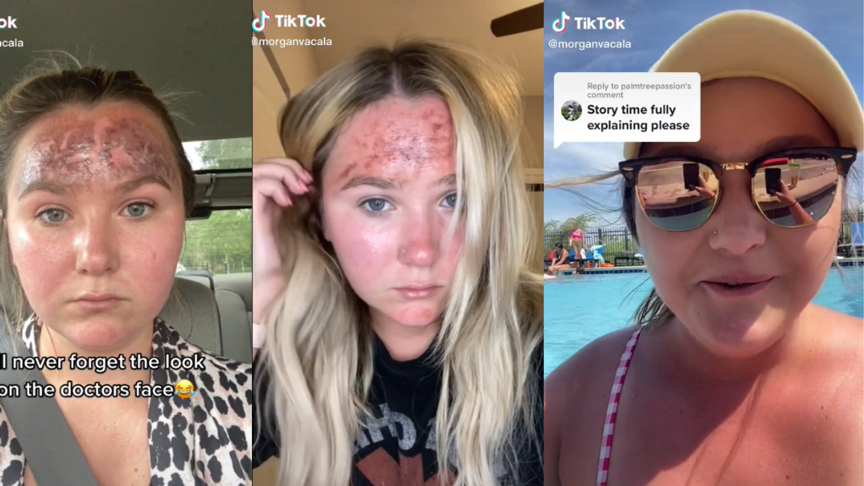 TikToker Warns Of The Dangers Of Using Expired Sunscreen After Suffering An Extreme Burn