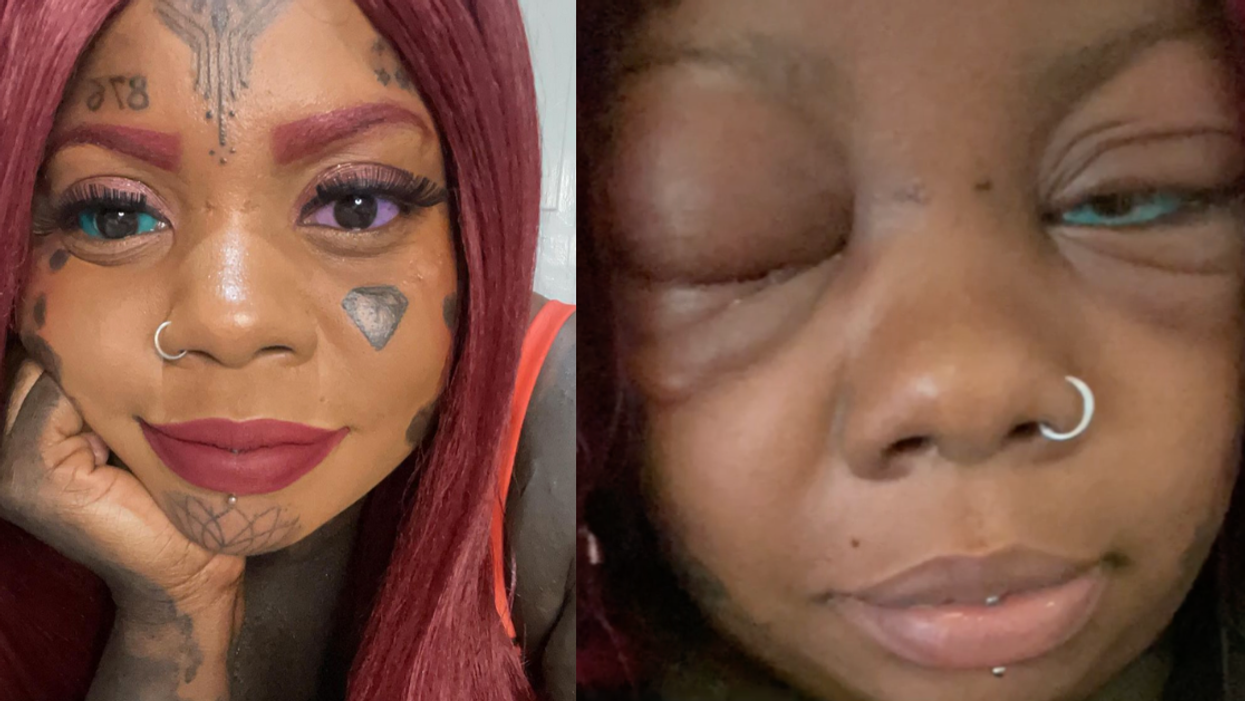 Mom Decided To Tattoo Her Eyeballs Blue And Purple—And Now She's Losing Her Vision