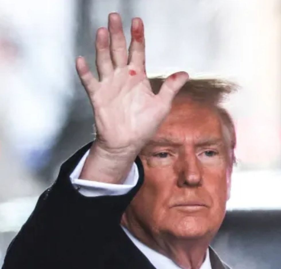 Photo of Donald Trump waving, exposing his blistered hand