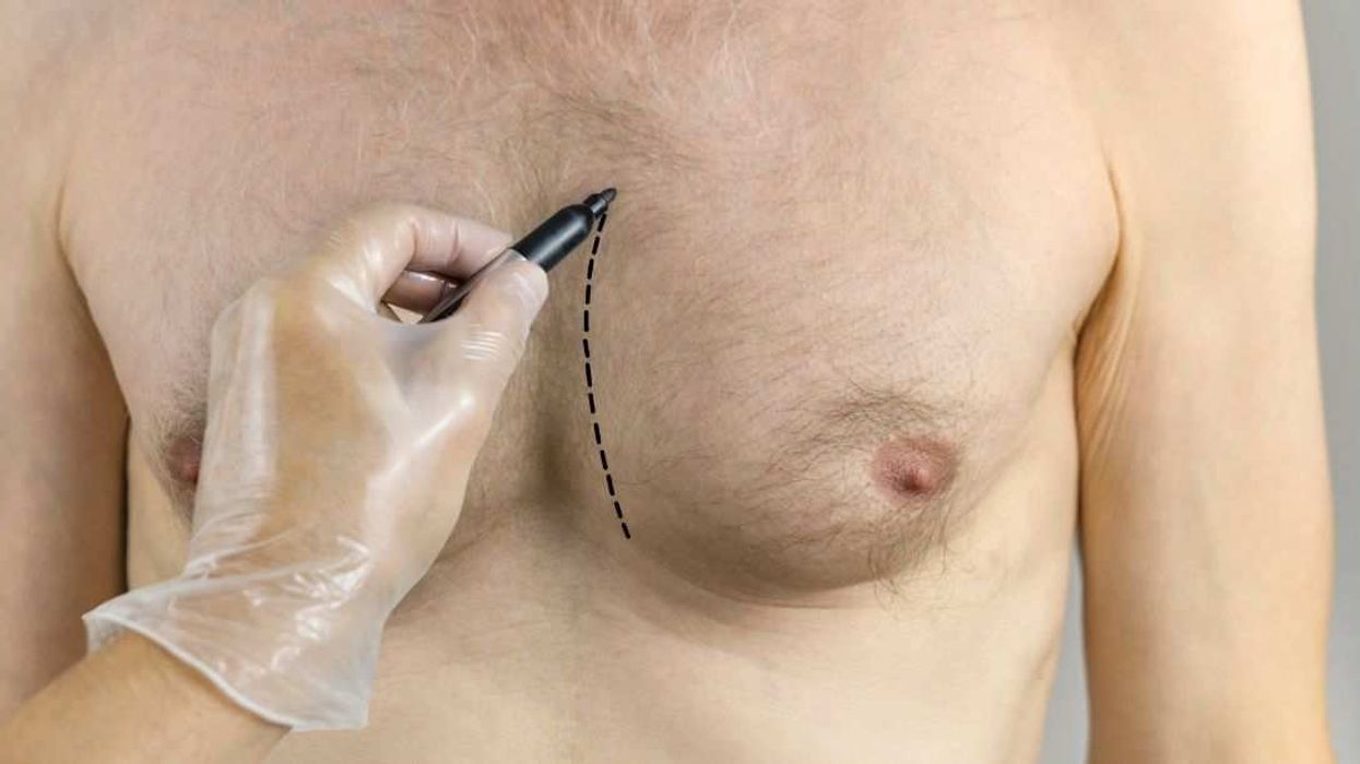 Plastic surgeon draws surgical plans before male breast reduction.