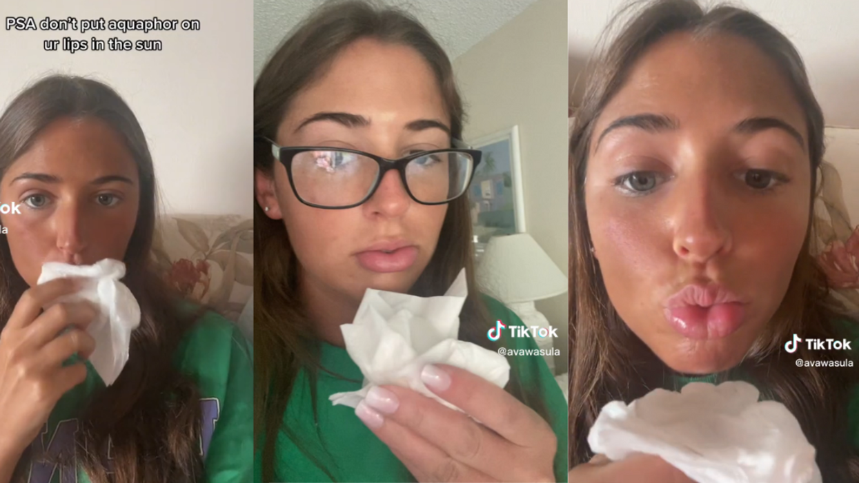 Woman warns against using Aquaphor in the sun to prevent burns